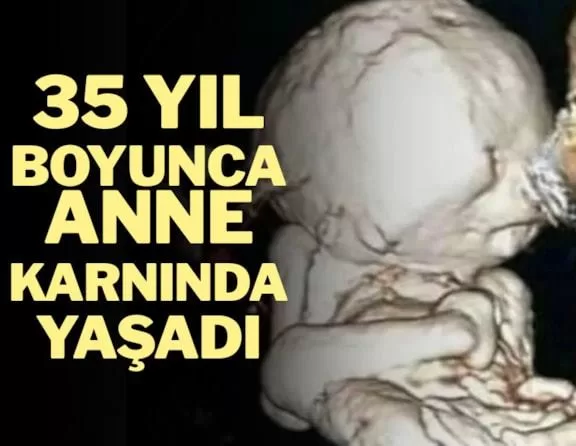 35 Yıl Boyunca Anne Karnında Yaşadı